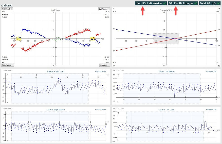 Caloric Testing